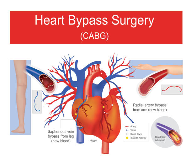 Best Heart Bypass Surgeon in Bandra
