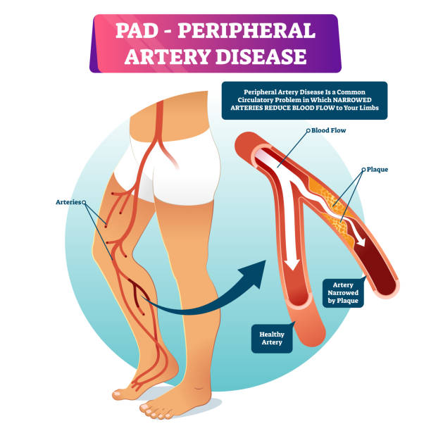 Best Peripheral Artery Disease Treatment in Bandra